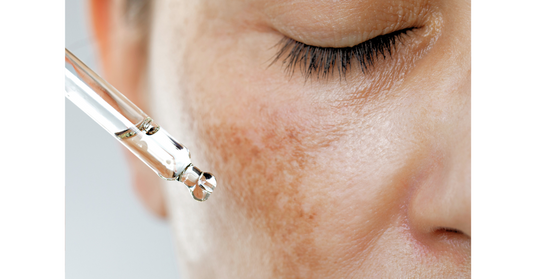 Hyperpigmentation: Why It Happens & How to Get Rid of It