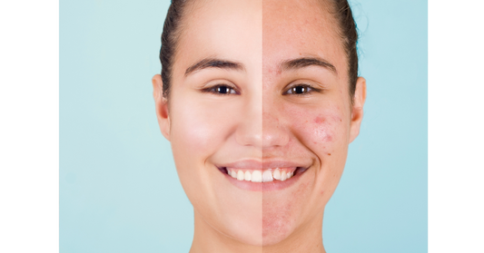 What Causes Acne & Best Skincare to Treat It