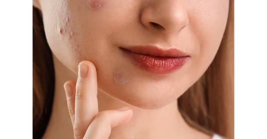 Shop Pimple Patches at Daeskin