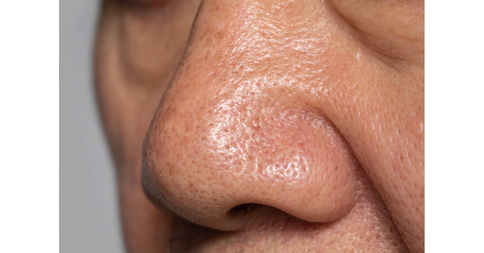 How to Get Rid of Sebaceous Filaments: Treatments & Tips