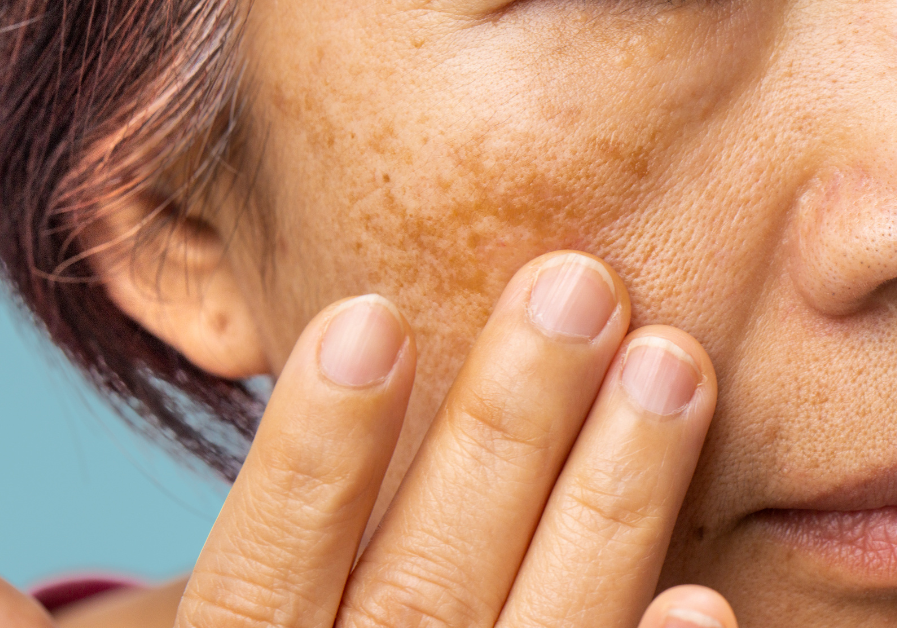 Best Korean Skincare for Melasma: How to Fade Dark Spots and Pigmentation