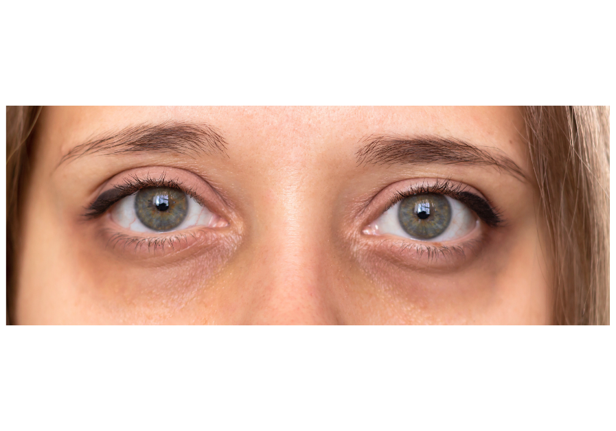 The Real Reason You Have Dark Circles (It's Not Just Lack of Sleep)